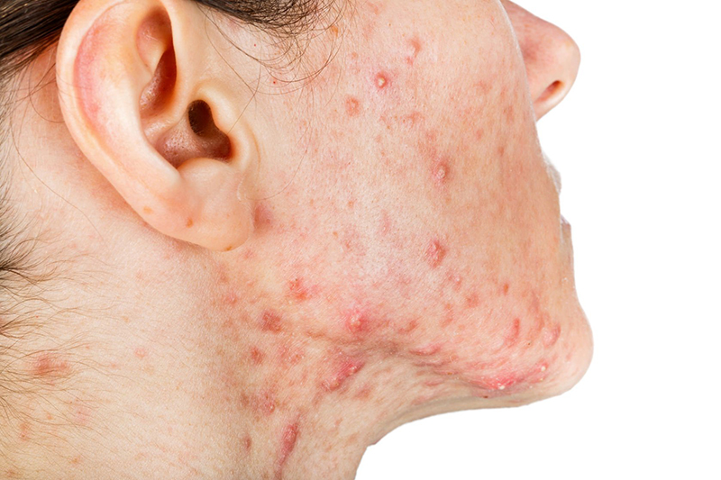 TYPES OF ACNE SHOULD NOT BE MOLDED